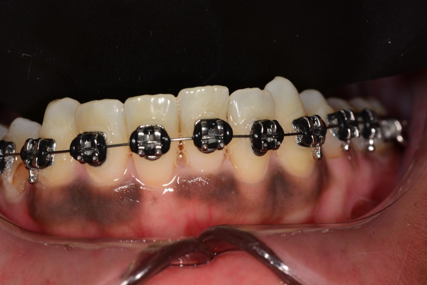 Beautifully aligned teeth after braces treatment