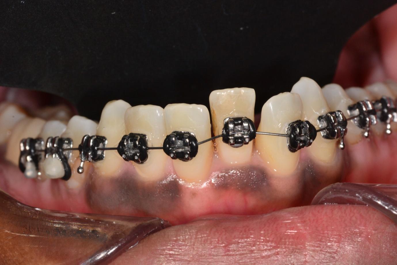 Braces gradually aligning a tooth into position